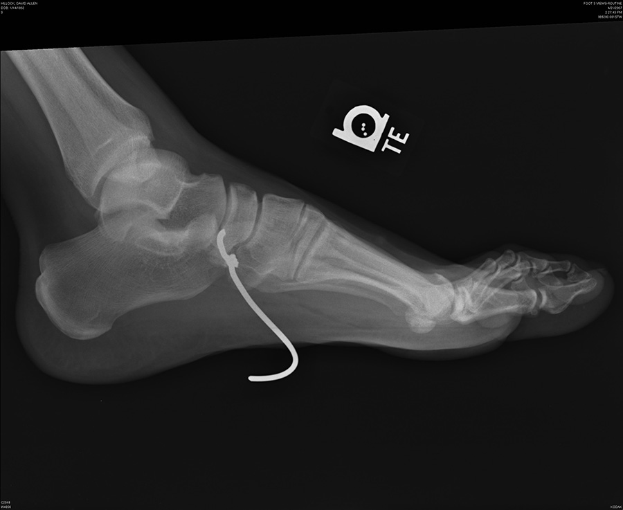 X-ray of a foot impaled by a piece of wire