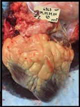 A close-up of a dissected bovine heart showing extensive deposits of yellow-white fat surrounding the heart muscle. A white identification tag is attached to the top portion of the heart.
